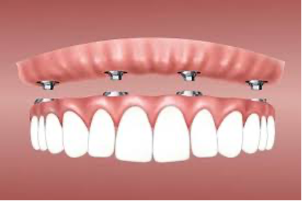 Implant Retained Dentures - Denture Services - Colorado Springs